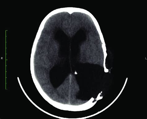Noncontrast Computed Tomography Of Head Showing Large Calvarial Defect