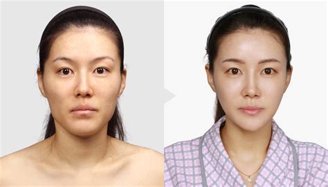 Korean Celebrities Before And After Plastic Surgery