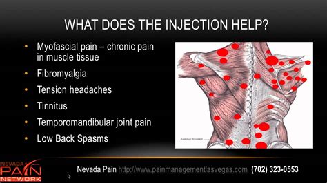 Trigger Point Injections Explained By A Las Vegas Pain Management
