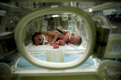 Conjoined Girl Twins Successfully Separated By Surgery Check Out Cute