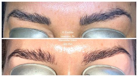 Permanent Eyebrow Makeup Removal With Laser Confido