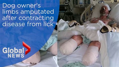 Dog Owners Limbs Amputated After Contracting Rare Infection From Lick
