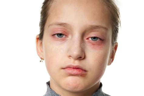 Réaction Allergique éruption Cutanée Portrait Proche De Vue Du Visage