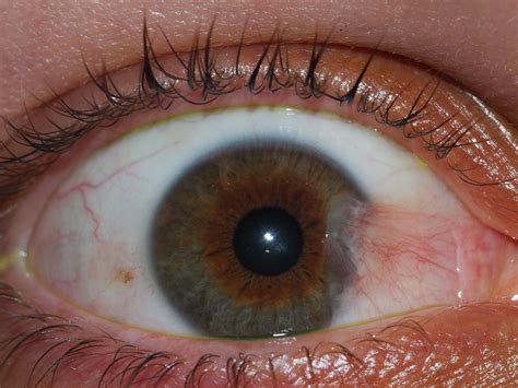 Pterygium Dr Tom Cunneen Eye Surgery Perth