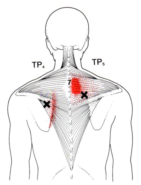 Trapezius The Trigger Point And Referred Pain Guide