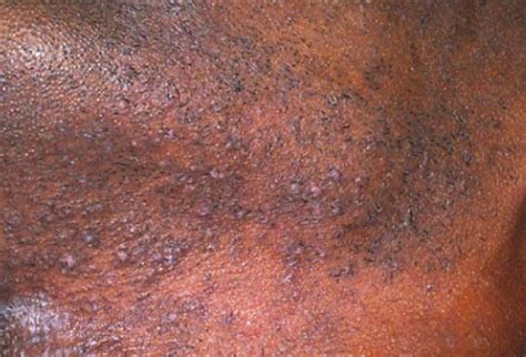 How often should you shave your vag? Rashes, Bumps, and Lumps Below the Belt: What you need to know