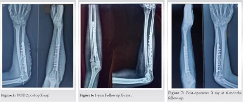 Old Monteggia Fracture Dislocation Treated With Plating And Forearm