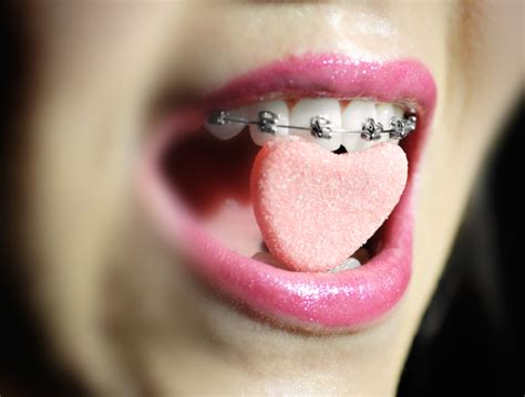 declinic czerniaków orthodontics cute braces valentines