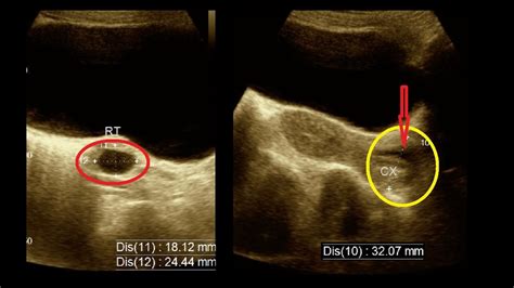 Cervicitis Adnexal Cyst Ultrasound Report KUB USG Full