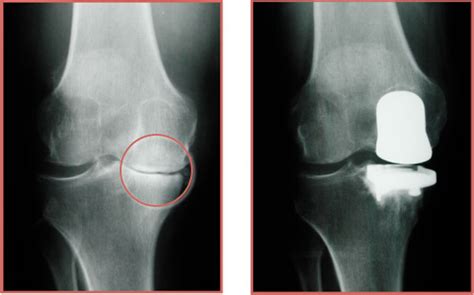 Dr Craig J Della Valle Hip And Knee Surgeon Partial Knee Replacement