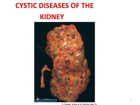 What Causes A Cyst To Form On Your Kidney