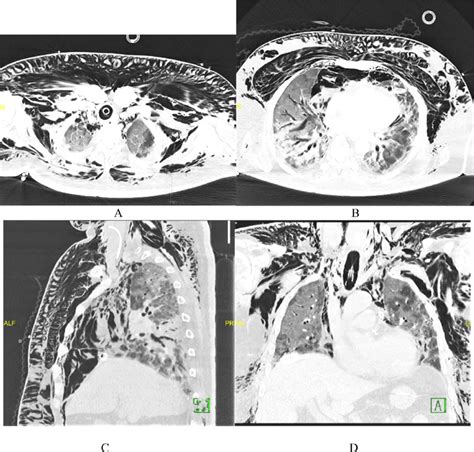 A To D Hrct Chest A And B Axial Images At The Level Of Proximal