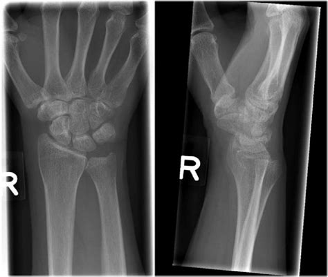 Plain X Ray Of Right Wrist Anteriorposterior View And Lateral View