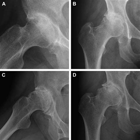 Hip Arthroscopic Synovectomy And Labral Repair In A Patient With