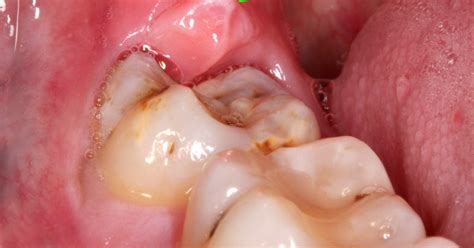 Wisdom Tooth Infection Dental Dentist