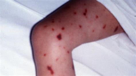 Two New Meningococcal Cases In Wa As Tally Hits 13 The Courier Mail