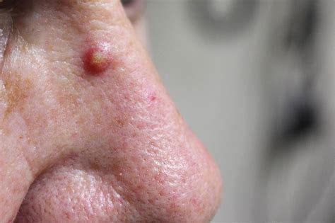 Solar Actinic Keratosis Victoria Skin Cancer Screening Early Hot Sex Picture