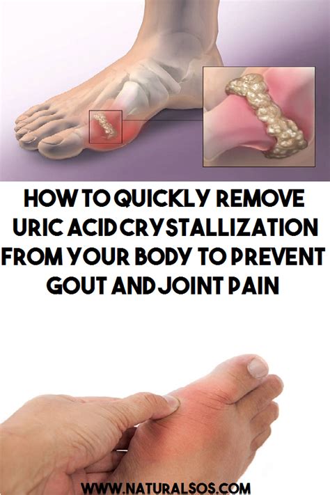 How To Relieve Gout Pain In Shoulder
