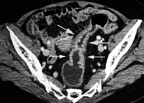 Sigmoid Colon On Ct Scan