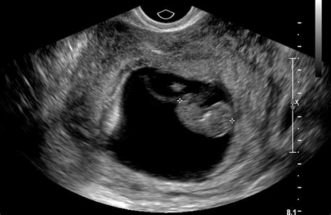 US Findings Of First Trimester Pregnancy RadioGraphics Fundamentals