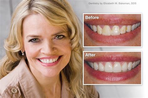 How Porcelain Veneers Change The Smile Wbccstar Best Cosmetic