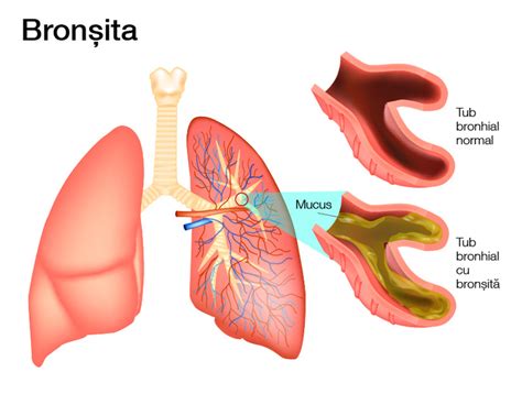 Bron Ita Cauze Simptome Diagnostic Si Tratament Policlinica Hot Sex