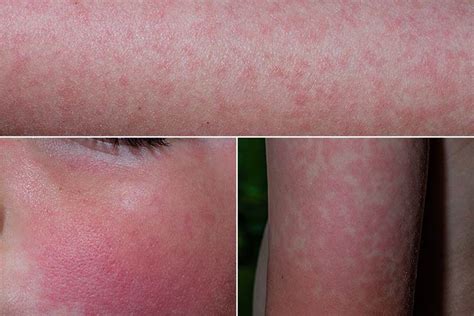 Common And Not So Common Rashes In Kids Fifth Disease Distinguish Vrogue