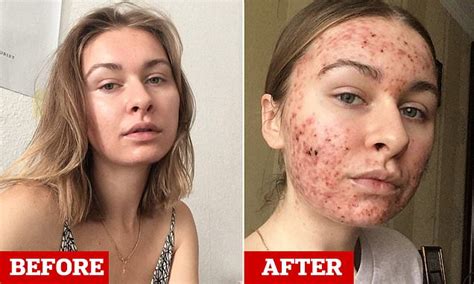 Woman 22 Shares Candid Selfies Of Severe Acne Which Suddenly Broke Out Across Her Entire Face