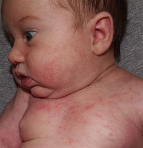 Learn about allergic skin reactions and what causes them. roseola rash on face - pictures, photos