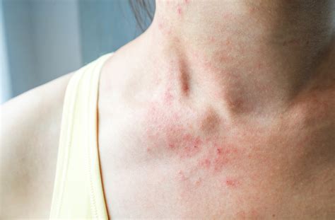 Dermatitis Rash On Chest
