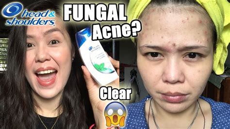 Get Rid Of Acne With Head And Shoulders Youtube
