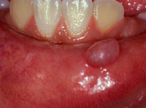 Image Gallery Mouth Lesions