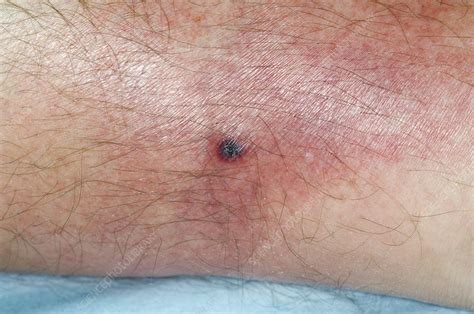Infected Horsefly Bite On The Leg Stock Image C0085588 Science