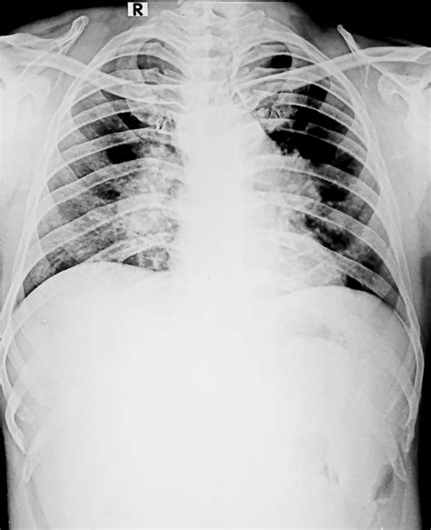X Ray Chest Pa View Showing Bilateral Hilar Lymphadenopathy Download