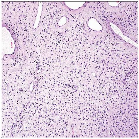 Superficial Cervicovaginal Myofibroblastoma Basicmedical Key