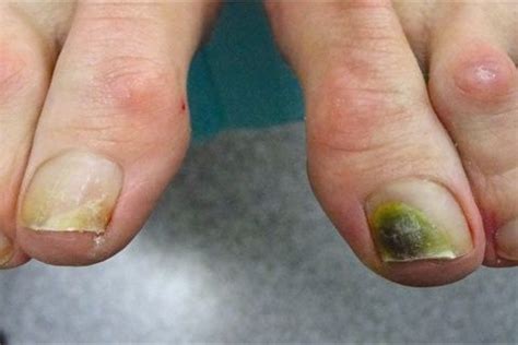 Fungus disease between toes can be recognized by characteristic itching on the surfaceskinthe spread of fungi is accompanied by reddening of the skin between the fingers, tooth, burning and discomfort. A Day in the Life of a Nail Doctor | Green toe nails, Dark ...