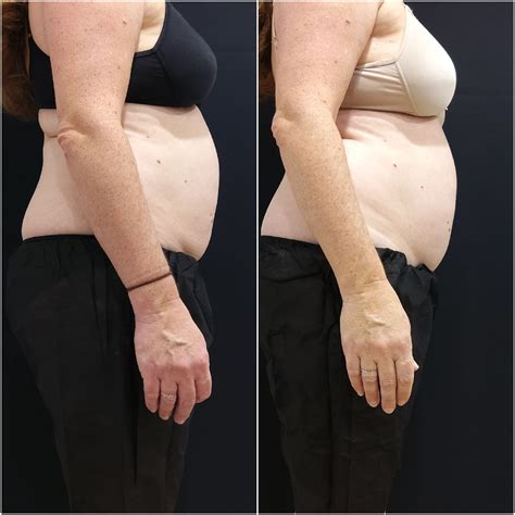 Aqualyx Fat Dissolving Injections Beautilase