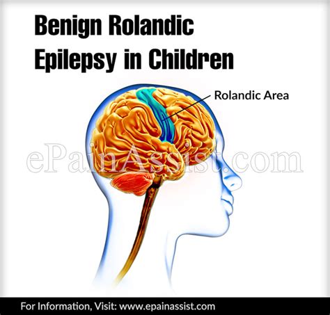 Benign Rolandic Epilepsycausessymptomstreatmentprognosis