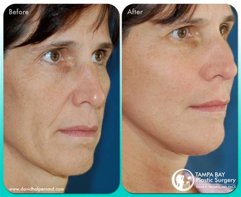 Facelift Tampa Rhytidectomy Tampa Bay Plastic Surgery