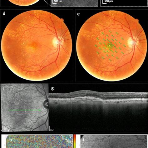 Representative Swept Source Optical Coherence Tomography Angiography