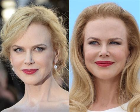 Nicole Kidman Before And After Plastic Surgery 21 Celebrity Plastic