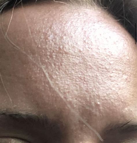 Tiny Bumps On Forehead Beauty Insider Community