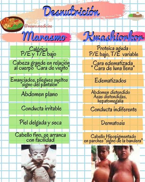 Desnutrición Marasmo Y Kwashiorkor Neuromedicine Udocz