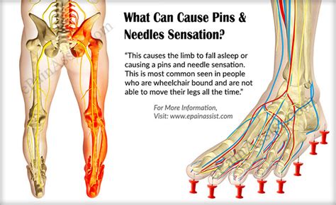 What Can Cause Pins And Needle Sensation And How Is It Treated
