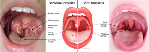 Tonsillectomy And Adenoidectomy T A Fort Worth ENT Sinus