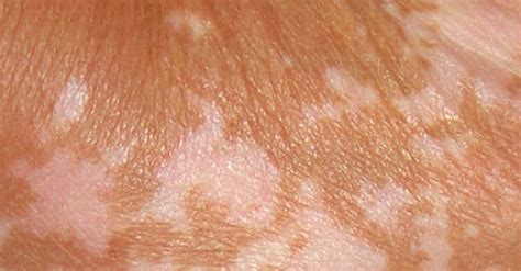 Reasons, causes, get rid, treatment. How to Get Rid of White Patches on Skin, Vitiligo | Top 10 ...