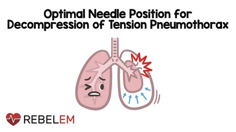Optimal Needle Position For Decompression Of Tension Pneumothorax
