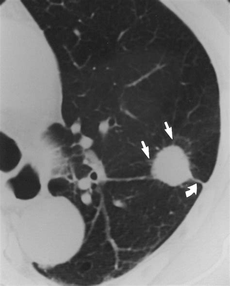 Ct Findings Of Surgically Resected Large Cell Neuroendocrine Carcinoma