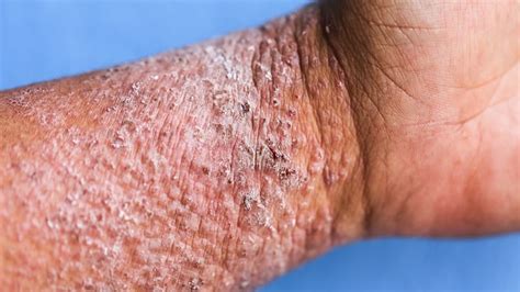Tralokinumab Gets Nod For Atopic Dermatitis In Europe Fitnessefficace