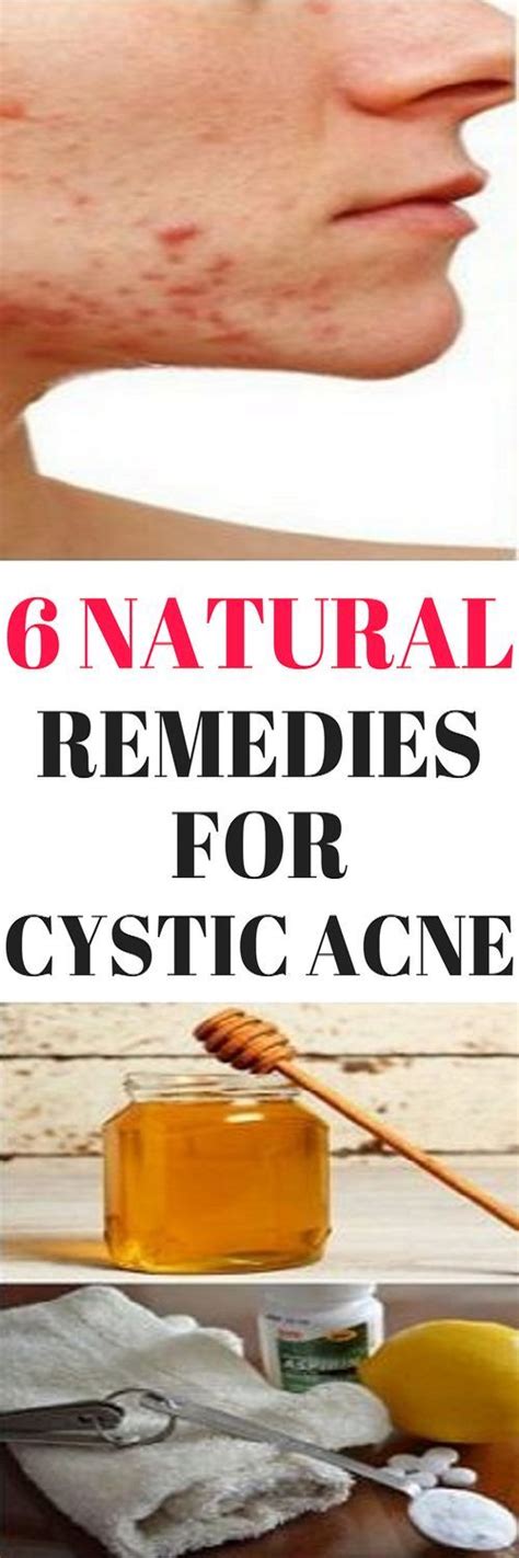 6 Natural Remedies For Cystic Acne Cystic Acne Remedies Cystic Acne